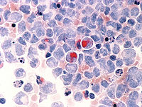 Бактерии, скрытые внутри опухолей, могут помочь победить рак