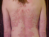 Псориаз у детей связан с разводом и расставанием родителей, показало исследование