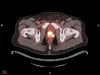 Мужчины предпочитают не говорить о проблемах с простатой