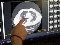 Кариес и заболевания десен могут почти удвоить риск инсульта Кариес и заболевания десен могут почти удвоить риск инсульта