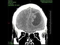 Израильские ученые предложили новый подход к лечению рака мозга