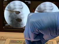 Стволовые клетки из жировой ткани могут восстанавливать переломы позвоночника