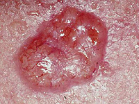 ИИ ускоряет разработку вакцины против рака кожи