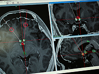 Неизлеченное апноэ во сне повышает риск болезни Паркинсона, показало исследование Неизлеченное апноэ во сне повышает риск болезни Паркинсона, показало исследование