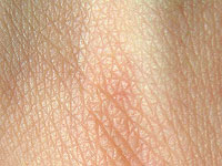 У кожи есть встроенная защита от рака, и солнечный свет ее отключает