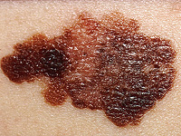 Татуировки могут быть фактором риска развития меланомы