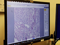 Во время беременности плацента может стареть слишком быстро