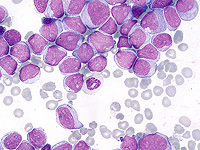 Исследователи обнаружили, что препарат от рака груди повышает эффективность лечения лейкемии Исследователи обнаружили, что препарат от рака груди повышает эффективность лечения лейкемии