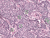 Раковая клетка сама ломает свою ДНК, и это можно использовать против нее