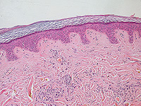 Израильские ученые нашли ген в клетках кожи, который помогает ее иммунной защите