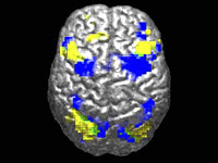 Новая модель ИИ может расшифровывать МРТ головного мозга за секунды