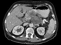 Нервные окончания активно способствуют развитию рака поджелудочной железы