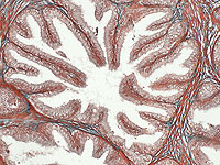 90% опухолей предстательной железы содержат микропластик