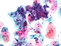 Мазки из щеки предлагают неинвазивный способ диагностики шизофрении Мазки из щеки предлагают неинвазивный способ диагностики шизофрении