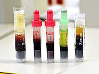 Новый анализ крови может выявить депрессию еще до появления симптомов