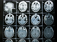 Тестостерон может подавлять рост опухолей головного мозга у мужчин