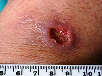 Вакцина против лейшманиоза переходит в первую фазу клинических испытаний