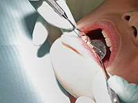 Израильские ученые показали, что воспаление полости рта может повлиять на развитие бесплодия