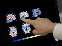 Впервые в мире недостающий ген доставили прямо в мозг младенца, страдающего эпилепсией