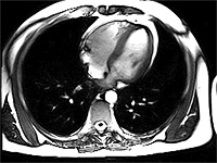 Изменения в работе сердца могут предсказывать будущий риск развития рака