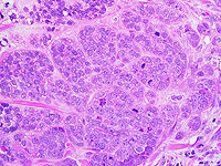 Медицина без лекарств: израильский прорыв в наномедицине раковых опухолей