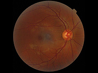 Фотографии сетчатки могут помочь предсказать факторы риска развития болезни Альцгеймера