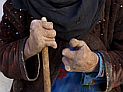 На Индию приходится 56% новых случаев проказы в мире: около 127 тысяч в год