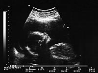 Врачам рекомендуется дважды делать УЗИ для установления выкидыша