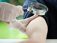 Родинки на руке могут указывать на повышенный риск заболевания раком кожи