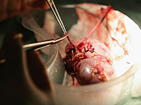 В 2015 году в Израиле был побит рекорд по числу операций по трансплантации почки