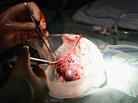 СМИ: в Иране можно приобрести почку для пересадки за 4,5 тысячи долларов