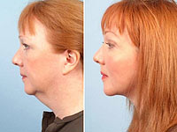 Как быстро и навсегда избавиться от двойного подбородка и обвисшей шеи