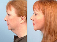 Двойной подбородок, обвисшая шея – избавляемся быстро и навсегда